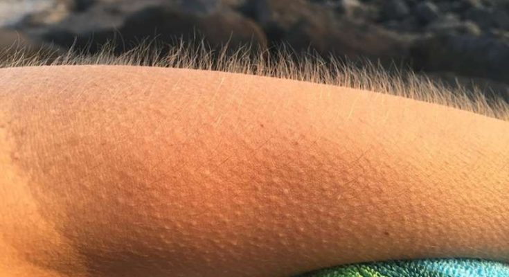 Hình ảnh nổi da gà 