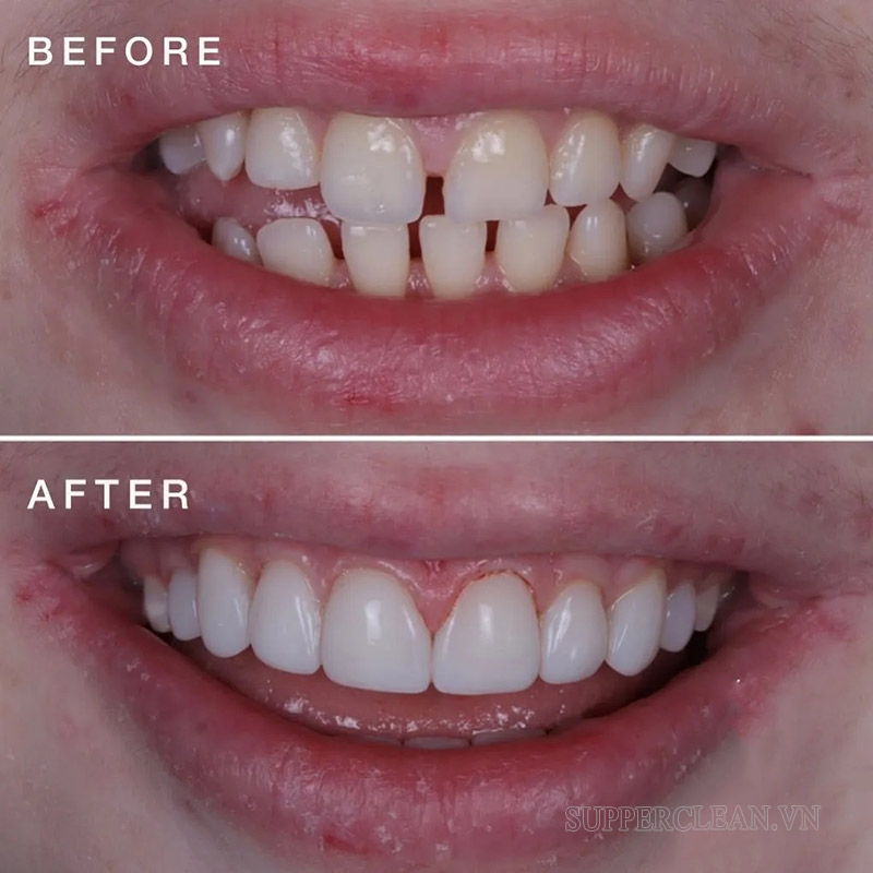 Hình ảnh hàm răng trước và sau khi dán composite